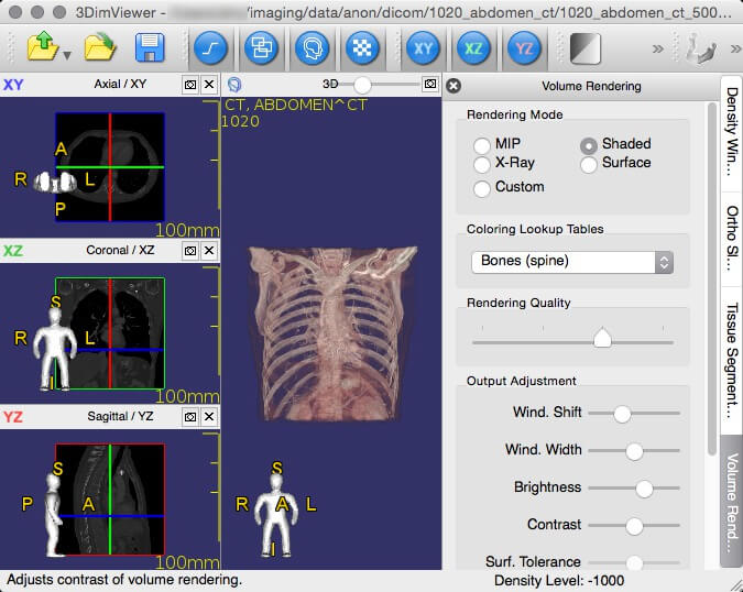 3DimViewer - Visionneuse 3D de Medical DICOM